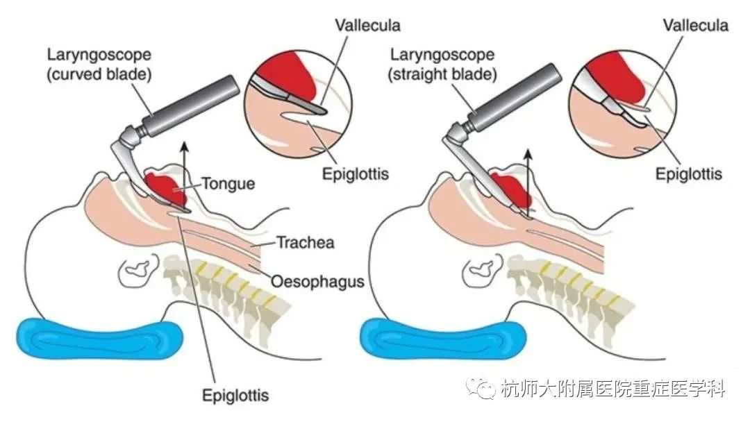 插管技术动态图解